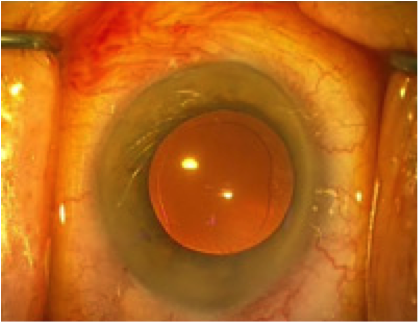 Oeil en fin d'intervention de cataracte