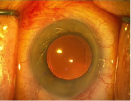Oeil en fin d'intervention de cataracte Oeil en fin d'intervention de cataracte