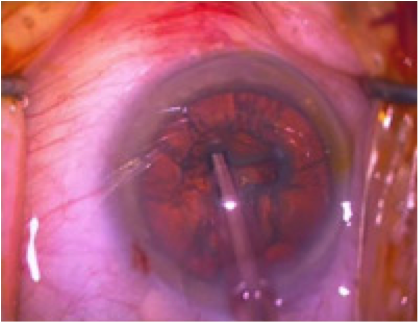 Ablation de la cataracte par phacoémulsification Ablation de la cataracte par phacoémulsification