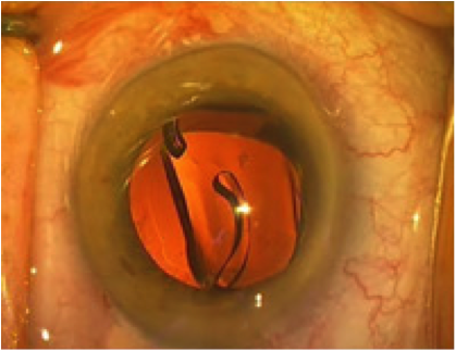 Injection d'un implant intraoculaire lors d'une cataracte Injection d'un implant intraoculaire lors d'une cataracte