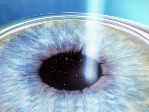 Chirurgie refractive